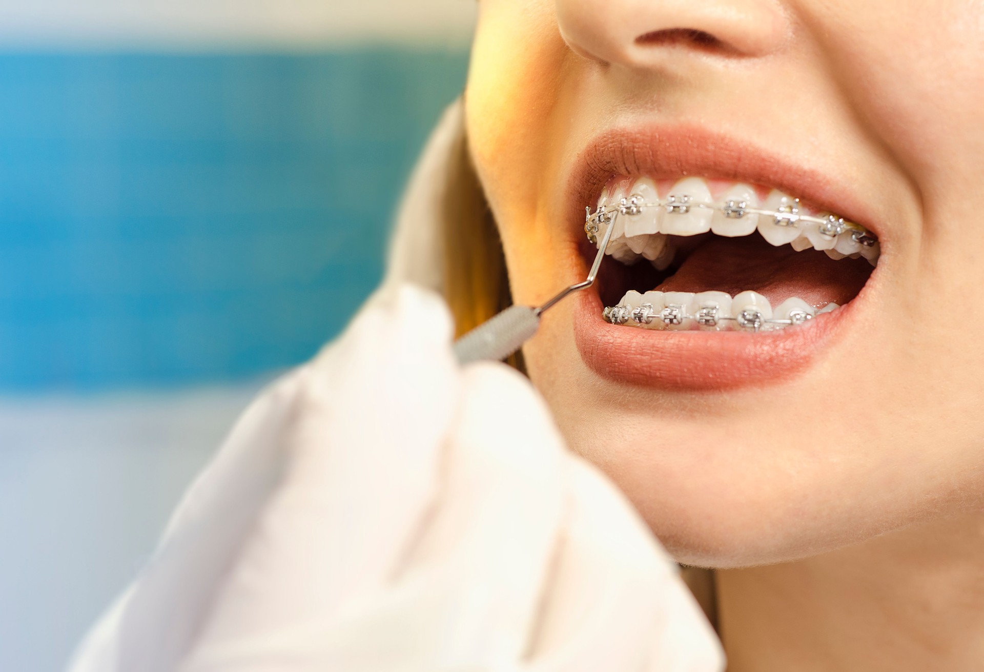 Closeup dental braces checkup